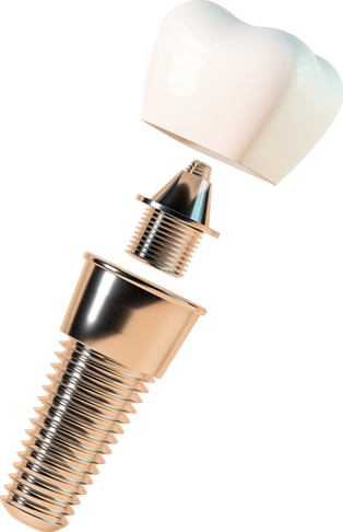3D dental-implants